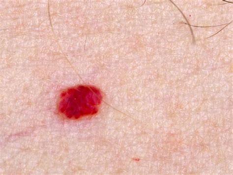 birthmark on penis|Penis Bumps: What it Means to Have a Genital Hemangioma